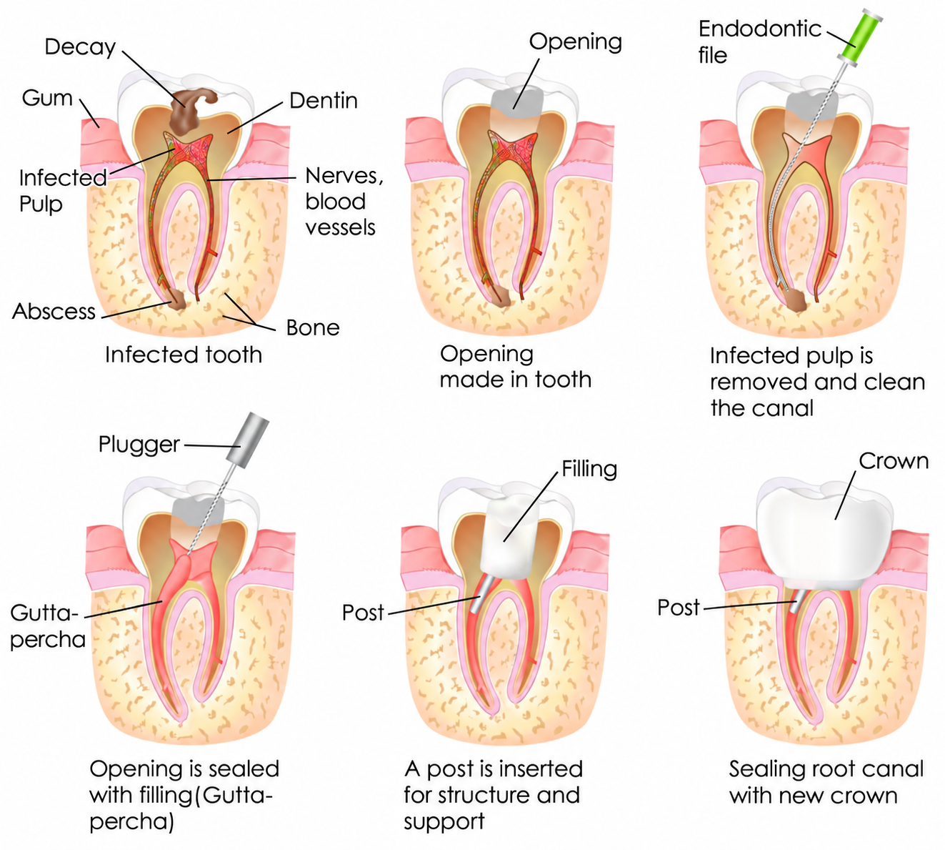 root-canal